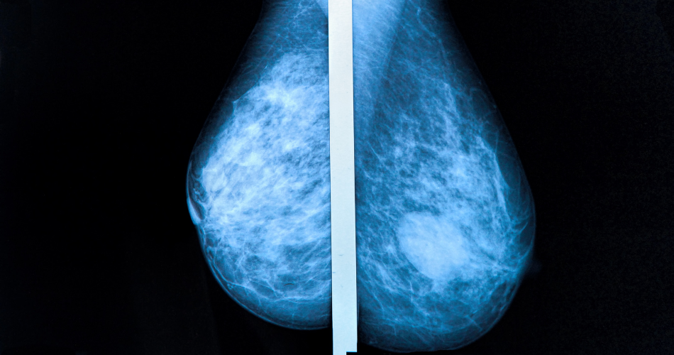 La Mammografia 3d nel monitoraggio delle lesioni benigne del seno