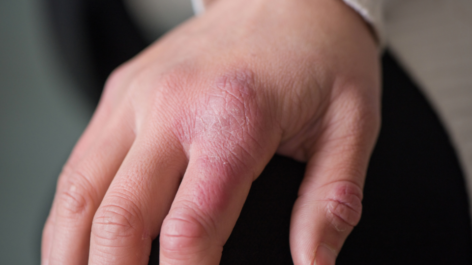 Geloni: come riconoscerli e come curarli