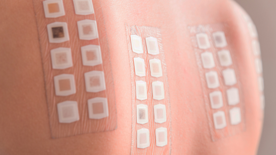 Patch test e sole: si può fare il test allergologico in estate?